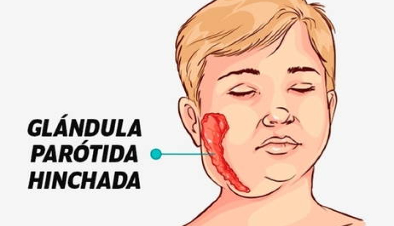 Alerta Epidemiológica: Preocupación por Posibles Casos de Paperas Atípicas en la Provincia