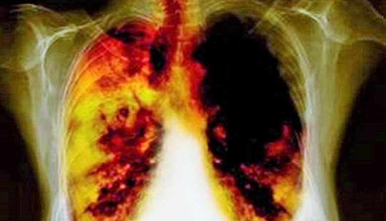 Fumar sigue siendo la principal causa de muerte por cáncer, a pesar de la caída en las tasas de tabaquismo