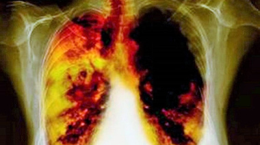 Fumar sigue siendo la principal causa de muerte por cáncer, a pesar de la caída en las tasas de tabaquismo