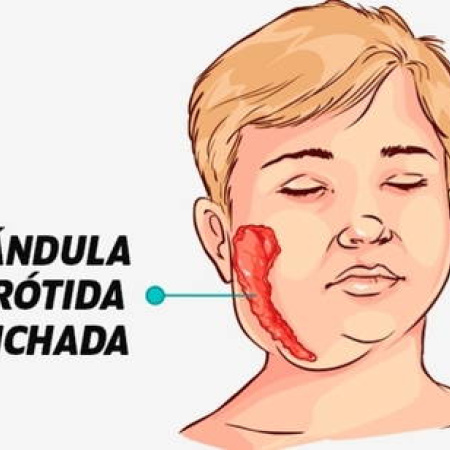 Alerta Epidemiológica: Preocupación por Posibles Casos de Paperas Atípicas en la Provincia