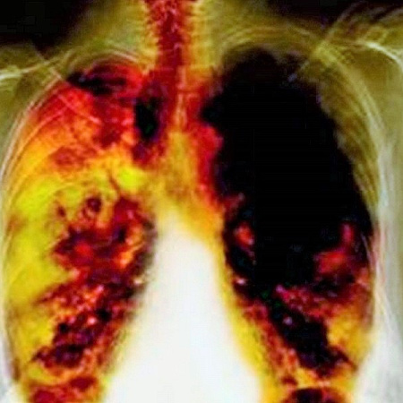 Fumar sigue siendo la principal causa de muerte por cáncer, a pesar de la caída en las tasas de tabaquismo